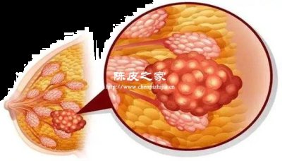 乳腺增生用陈皮泡水喝好吗