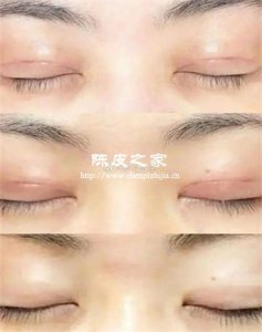 割了双眼皮可以喝陈皮泡的水吗