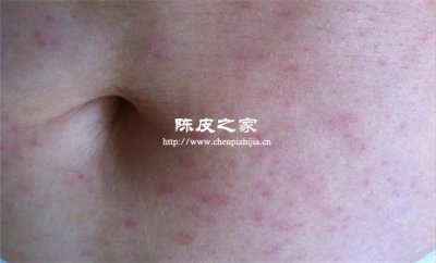 38度喝蚕砂竹茹陈皮水有伤害吗